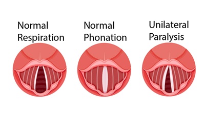 Illustration of unilateral paralysis
